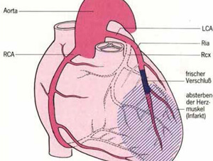 Herz mit Koronarien und skizziertem grossen Infarktareal bei proximalem Verschluss