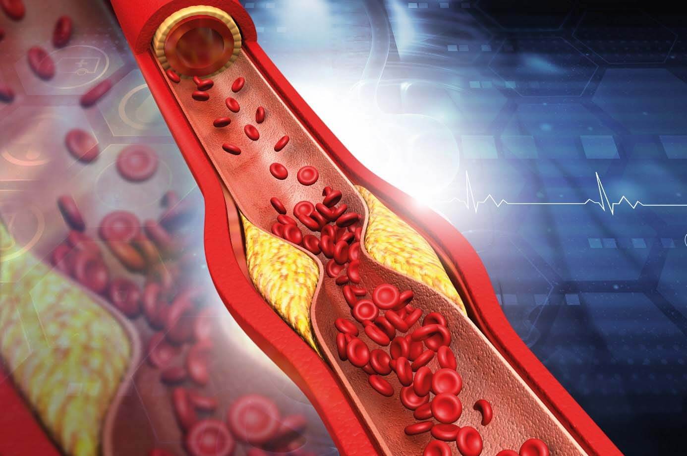 Atherosklerose: Prognosetools sollen Krankheiten frühzeitig erkennen